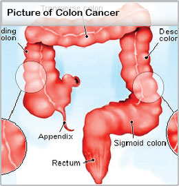 Colorectal Cancer