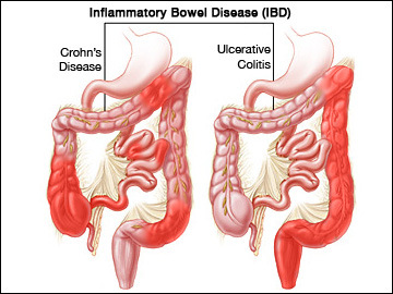 Inflammatory bowel diseases